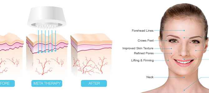 remove fine lines from eyes.